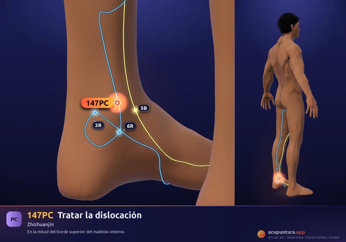 Localización del punto 147PC, Tratar la dislocación
