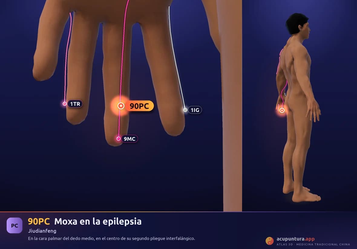 Localización del punto 90PC, Moxa en la epilepsia